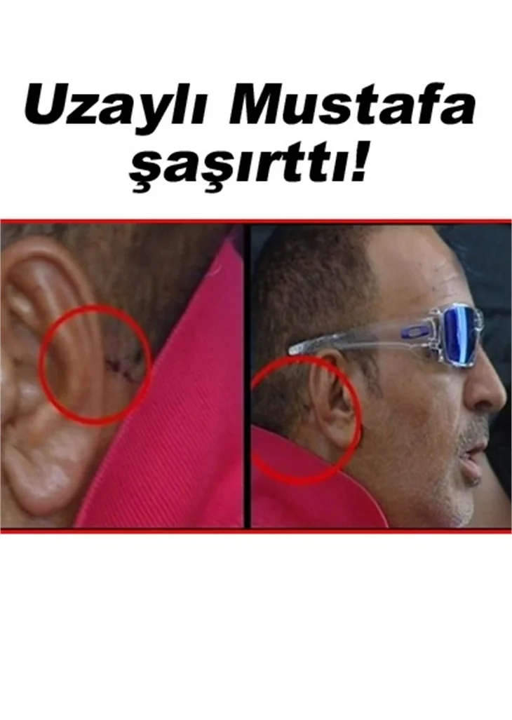 TOPALOĞLU, ESTETİK AMELİYAT MI OLDU?