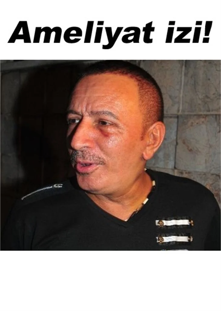 TOPALOĞLU BİR KEZ DAHA ESTETİK Mİ OLDU?