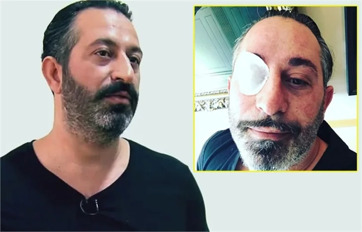 Cem Yılmaz'ın gözüne ne oldu?