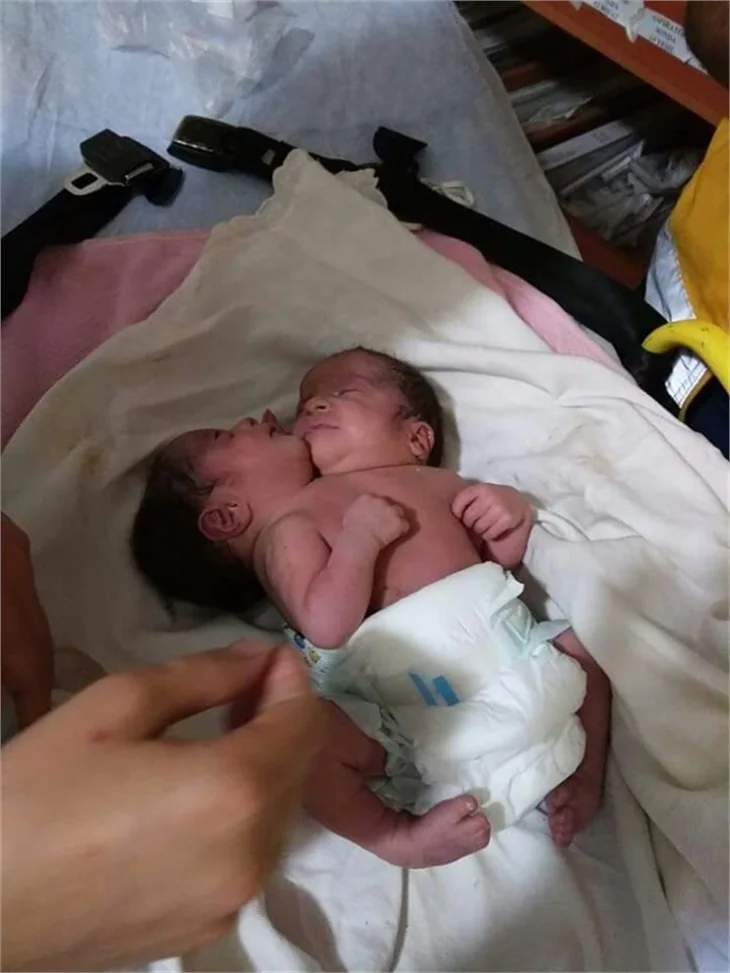 Çift başlı bebek tedavi altına alındı