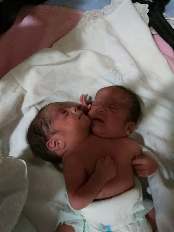 Çift başlı bebek tedavi altına alındı