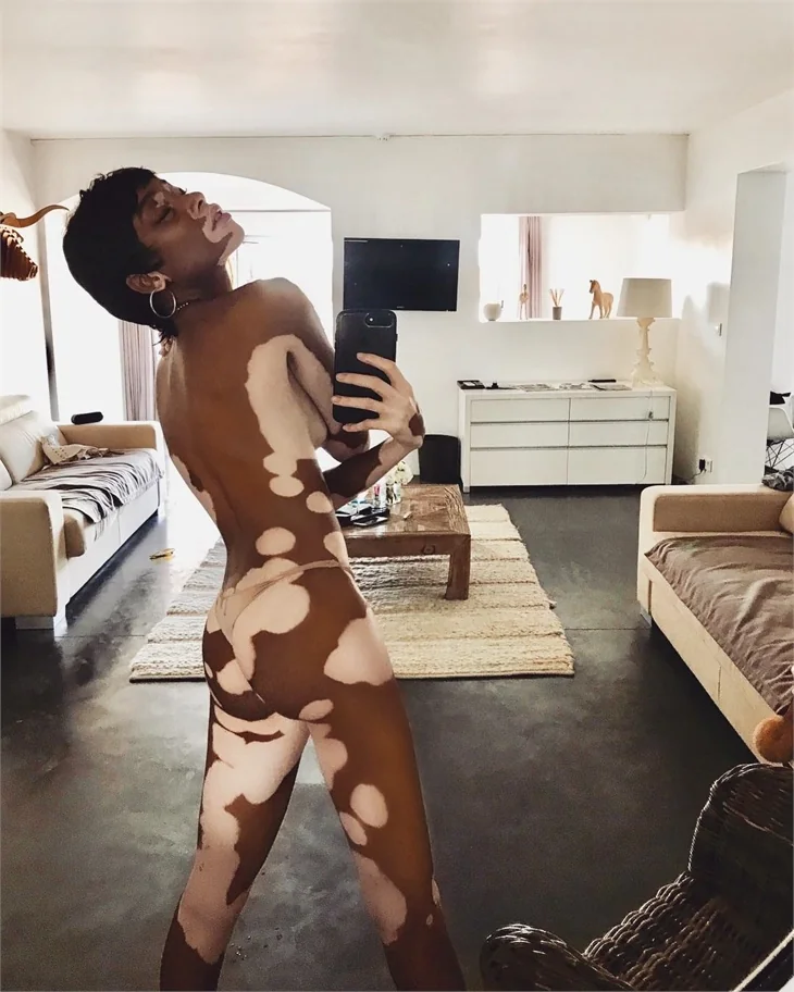 Winnie Harlow hastalığına böyle meydan okuyor!