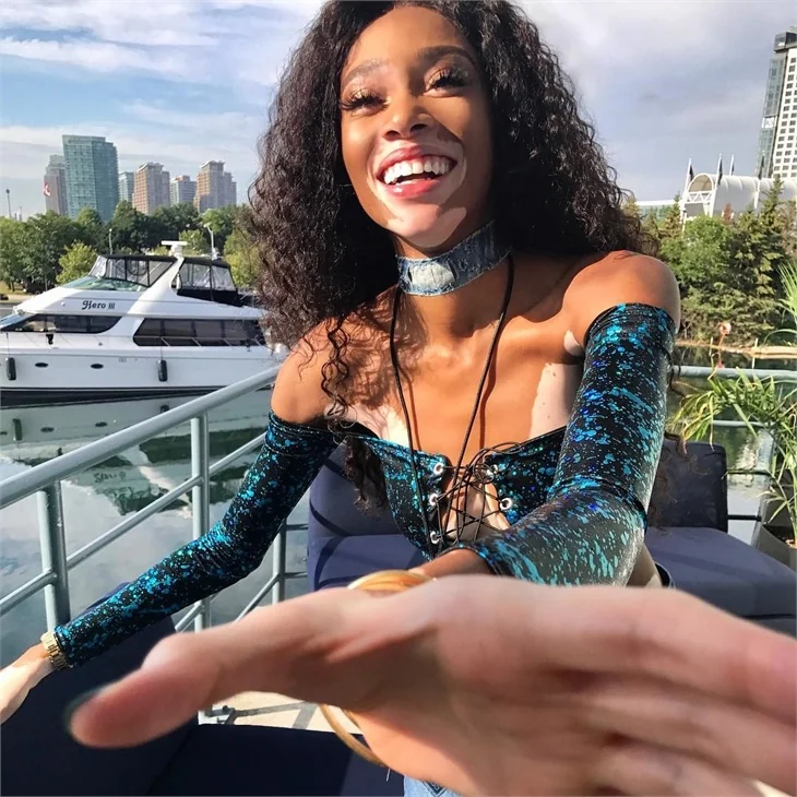 Winnie Harlow hastalığına böyle meydan okuyor!