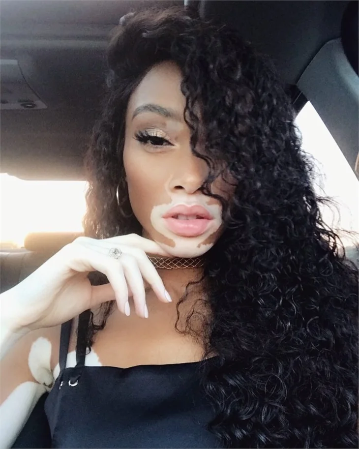 Winnie Harlow hastalığına böyle meydan okuyor!
