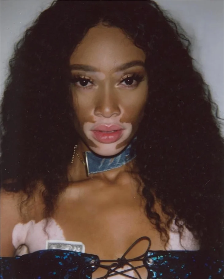 Winnie Harlow hastalığına böyle meydan okuyor!