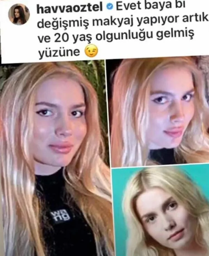 Aleyna Tilki'nin dudakları nasıl şişti?