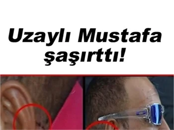 TOPALOĞLU, ESTETİK AMELİYAT MI OLDU?