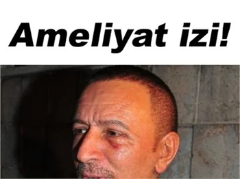 TOPALOĞLU BİR KEZ DAHA ESTETİK Mİ OLDU?