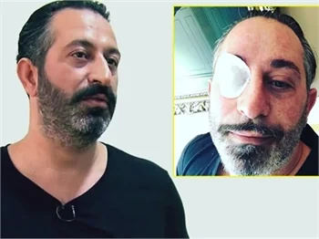 Cem Yılmaz'ın gözüne ne oldu?