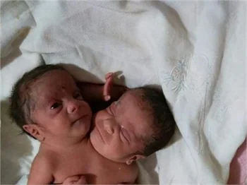 Çift başlı bebek tedavi altına alındı