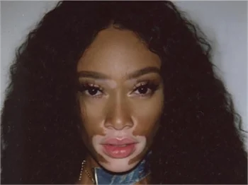 Winnie Harlow hastalığına böyle meydan okuyor!